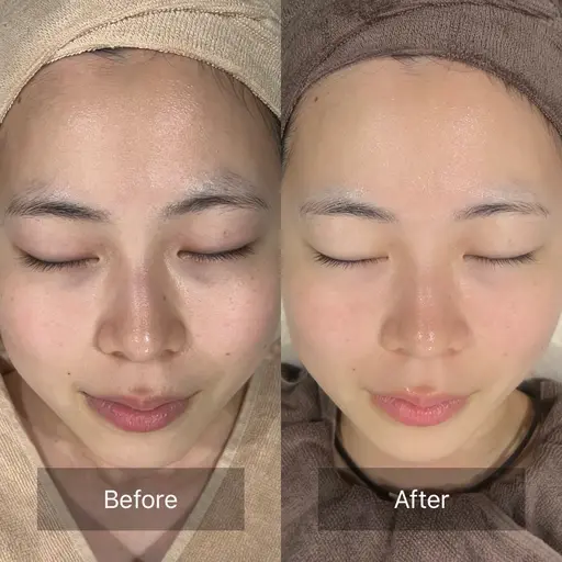 【人気No.1✨️】肌質改善1ヶ月集中モニター🎀1ヶ月分のスキンケア6点セット＆4回のエステ付き🤍