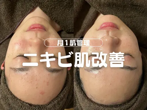【人気No.1🥇】オーダーメイド肌質改善🌿【肌タイプに合わせたオーダーメイド施術💎💎フルオプション込み価格】