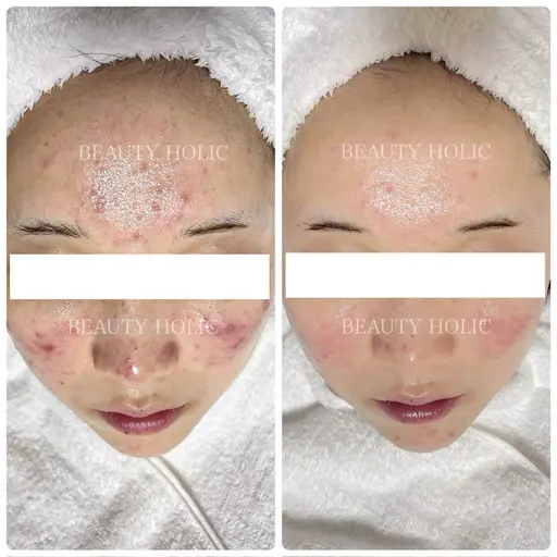 どうしたらニキビが治るのかわからない…自分では限界を感じている方👉150通りの施術からあなたに合わせた施術をご提供🌈