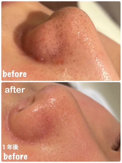 発光肌がかなう✨✨【全顔】毛穴洗浄😶‍🌫️×ビタミンC超音波導入🍋 口コミ価格🙇🏻‍♀️