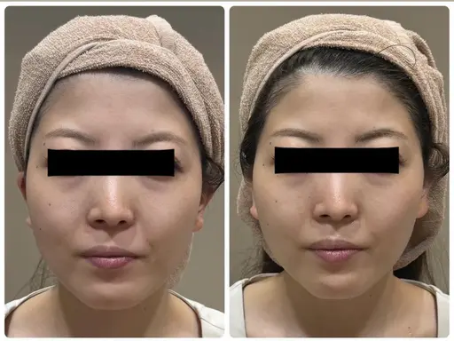 ✨人気No.1✨お顔の脱毛ならお任せください✨毛&毛穴の両方にWの効果で毛穴レス肌🫧IPL照射で効果絶大の声多数