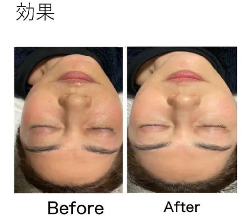 優しい剥離なしのハーブピーリング➕人幹細胞美容液をたっぷり入れこんでいきます【現金かpaypay】