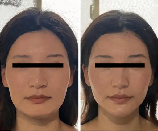 小顔矯正✨二重あご・たるみ・むくみ・エラの張り改善❣