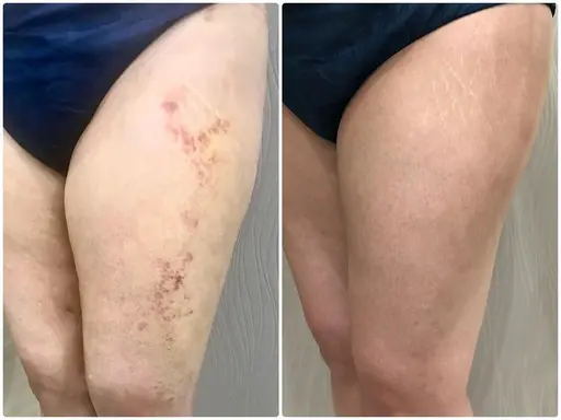 【美脚・術後ケア】むくみもピーマン尻も!下半身絞り上げ痩身ケア60分