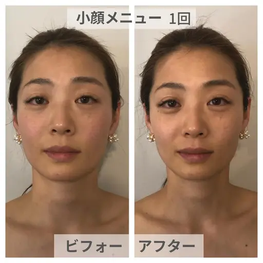 【小顔3Dリフト】50分💎ラジオ波で温め＆ハンドでほぐす！即効むくみオフ×立体フェイス✨