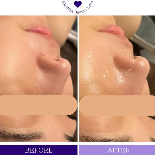 【ミニモ限定】大人気光フェイシャル➕美肌モデパック付 ➕デコルテマッサージ 45分