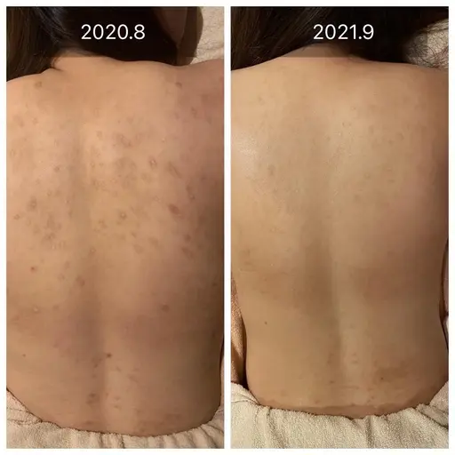 【💚背中を綺麗にしたい方💚】背中ハーブピーリングでツルツル🌿😭ニキビ・ニキビ跡・ザラつき・色素沈着を改善❣️