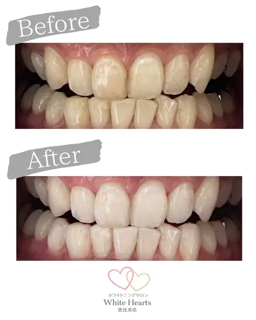 ホワイトニング