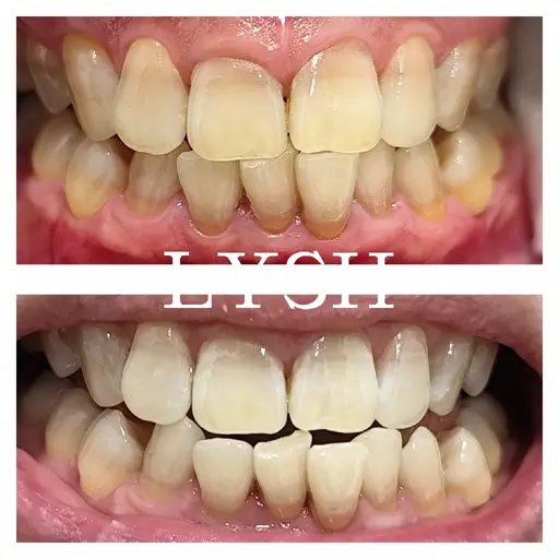 45分で歯の色にトーンアップ🦷セルフホワイトニング