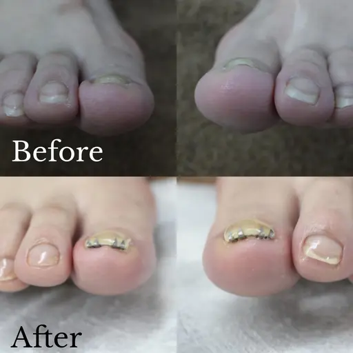 【モニター限定募集！】巻き爪矯正(丁寧甘皮ケア付)３回コース