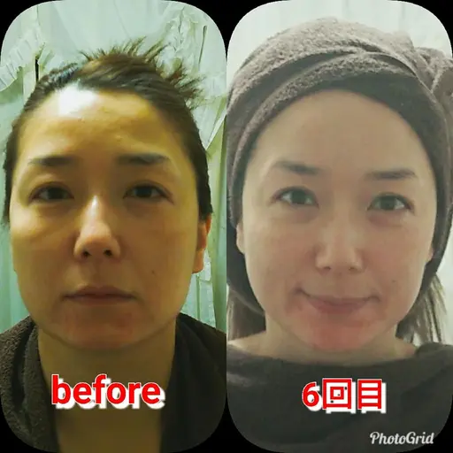 たるみに！超絶リフトアップフェイシャル※お写真掲載OKの方さらに割引🈹
