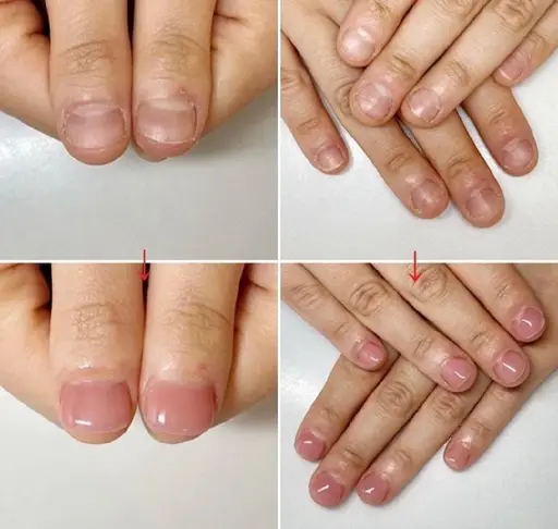 見た目重視の方に💅深爪矯正|長さだし+ワンカラー