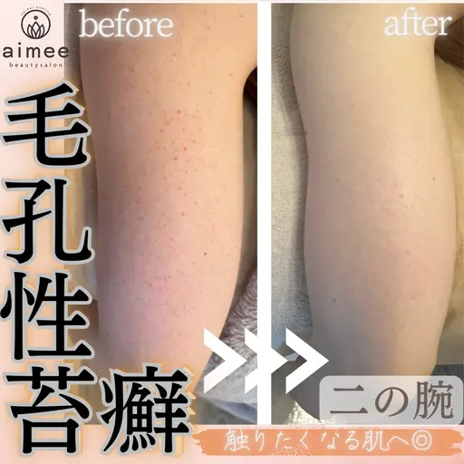 【二の腕ハーブピーリング】剥離なし🌿気になるプツプツ・ざらつきに◎