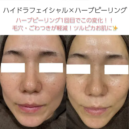 【初回体験】徹底毛穴！ツルピカ水光肌✨ハイドラフェイシャル&ハーブピーリング🌿