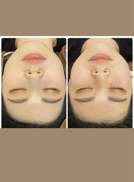 結果重視❗️5名様限定特典💆‍♀️💗小顔ケア4000ショット‼️特別価格にて🥰