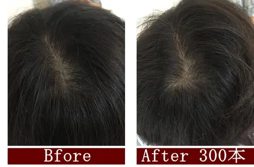 ヘアーループ増毛　３００本