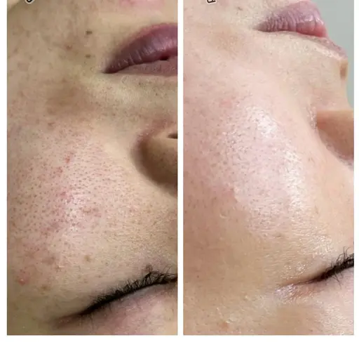 土日限定✨肌診断付💓【韓国で大人気水光肌✨️】大人気水光ピール✨毛穴レス、繰り返すニキビなど、憧れのツヤ感水光肌へ💕