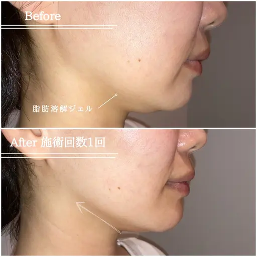 満足度100%！【小顔★フェイスラインの脂肪ぶんかい】気になる二重顎やフェイスラインをスッキリ横顔美人に♪