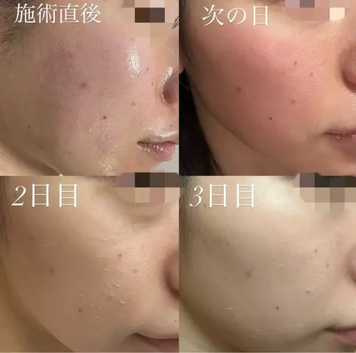 【今だけ‼️minimo限定キャンペーン価格✨🌿】剥離ありハーブピーリング💕🥚