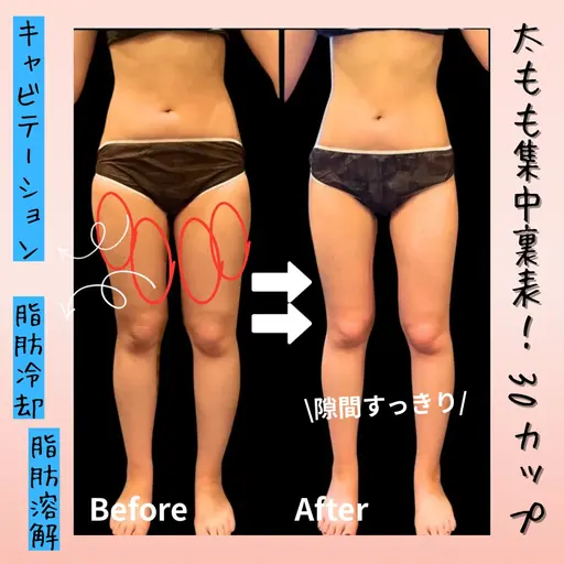 【本気痩せならコレ】冷却痩身で“落ちない脂肪”に直接アプローチ