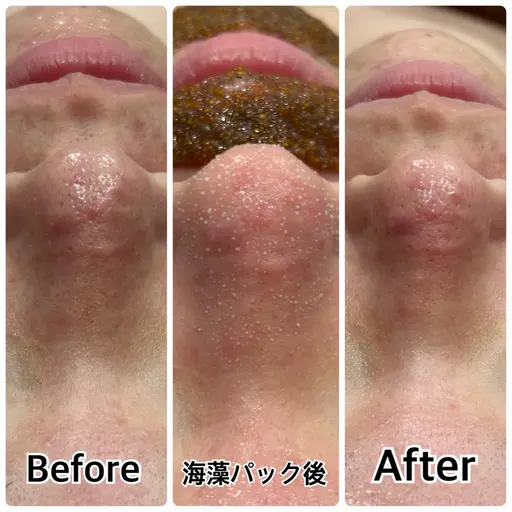 【新規女性/平日限定/この春褒められる肌作り】毛穴洗浄＋顔無VIO込全身脱毛