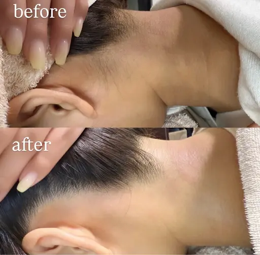 後ろ姿美人✨うなじWAX＋光脱毛