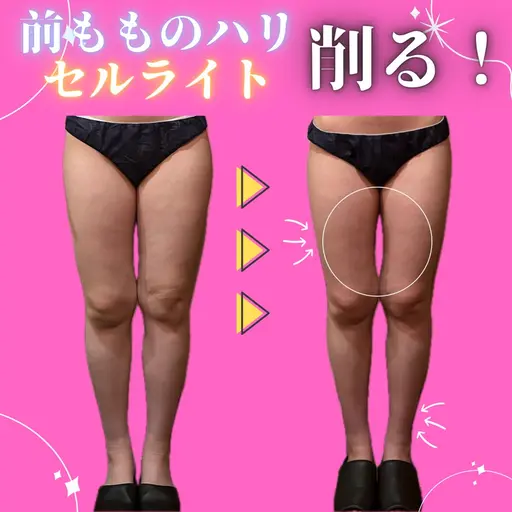 足痩せ人気No.1✨筋肉太り、むくみ、セルライト頑固な脂肪を必ず削ぎ落す🔥サイズダウンしながら痩せやすい身体に🐰ིྀ