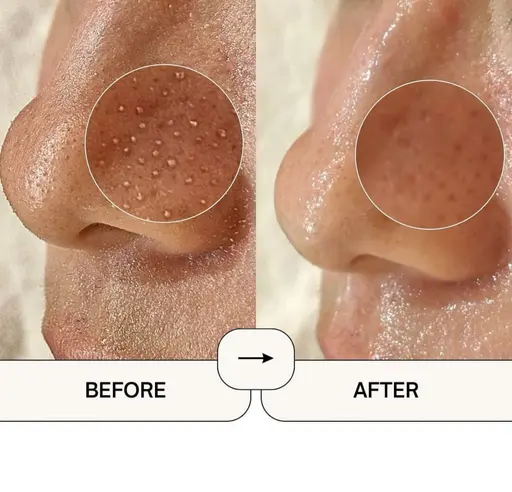 【minimo限定価格💡🩵】韓国式毛穴洗浄🇰🇷🫧男女◎❕黒ずみ/いちご鼻/角栓汚れ ¥5,500➝¥3,980