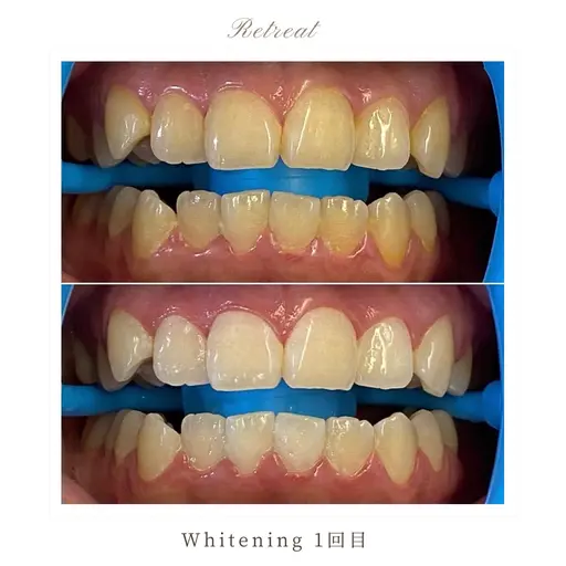 【ホワイトニング初めての方へ】ライトコース 1回/4回照射