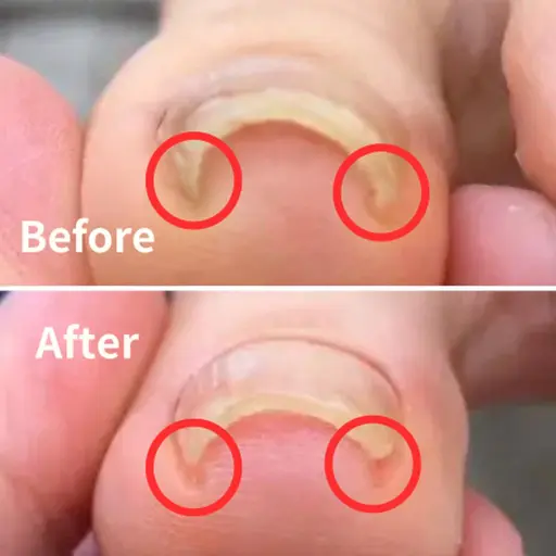 ☘️痛みを緩和☘️【巻き爪ケア】モデル