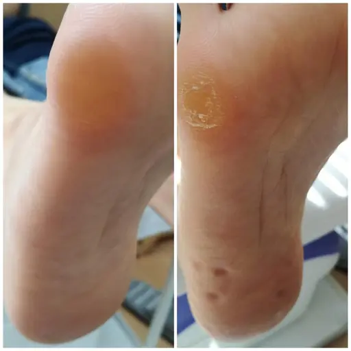 足裏ふわふわ角質ケア