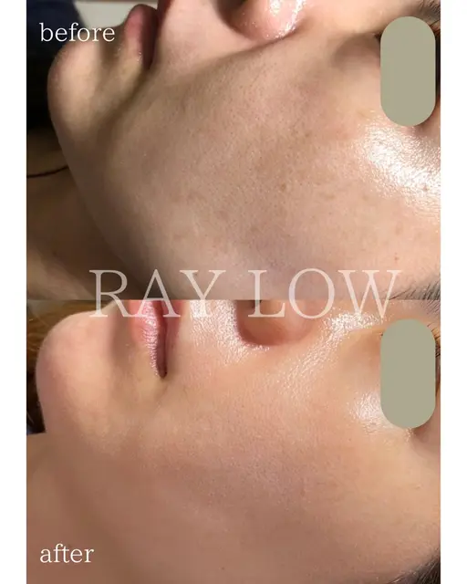 【毛穴レス/水光肌】RAY LOW式ロイヤルグロウフェイシャル｜水光ピーリング＋モデリングパック＋デコルテマッサージ付き