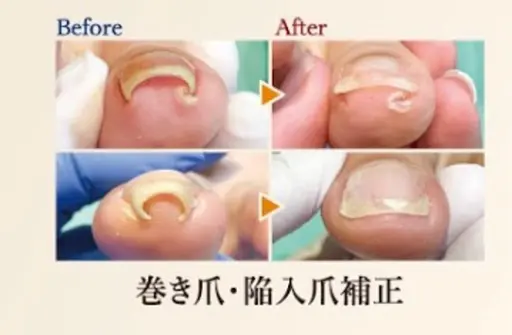 【陥入爪補正】1爪の巻き爪補正✨皮膚に沈み込んだ爪も補正器具でキレイに再生✨