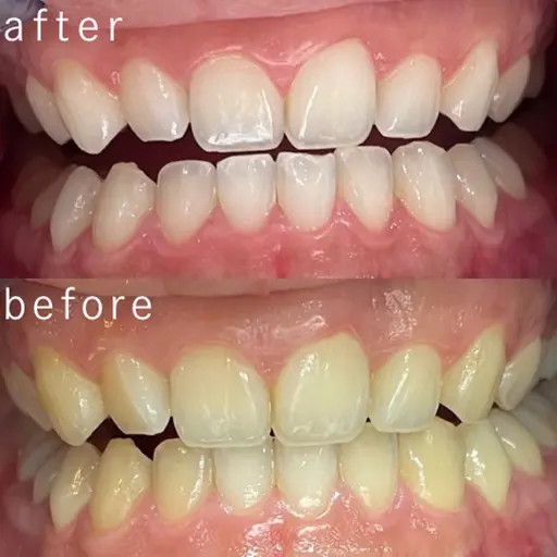 【しっかり白くさせるなら🦷✨】縛りナシ回数制限なし！🉐白さ実感×コスパ最強✨ホワイトニングのみの無制限コース😉✌️