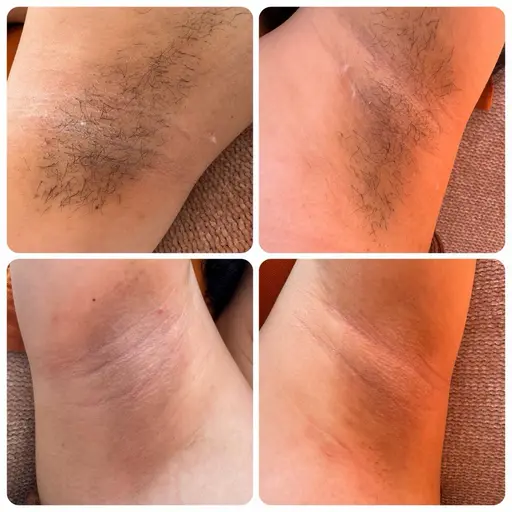 夏応援📣男女問わず歓迎✨両脇ブラジリアンWax脱毛！！事前処理なしで即日ツルツルへ