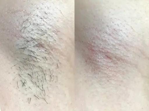 【ワキ脱毛】毛穴レスな脇を✨自信がもてる脇へ♡もう隠さないでいい脇になる!STOP🪒