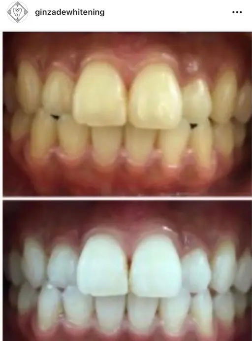 【通い放題プラン】効果No.1、納得する白さまで目指そう!セルフホワイトニングやり放題✨