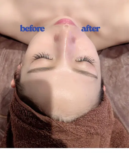 エステサロンで出来る次世代糸リフト🧖‍♀️顔の引き上げ・顎のたるみ施術後すぐに実感😳✨