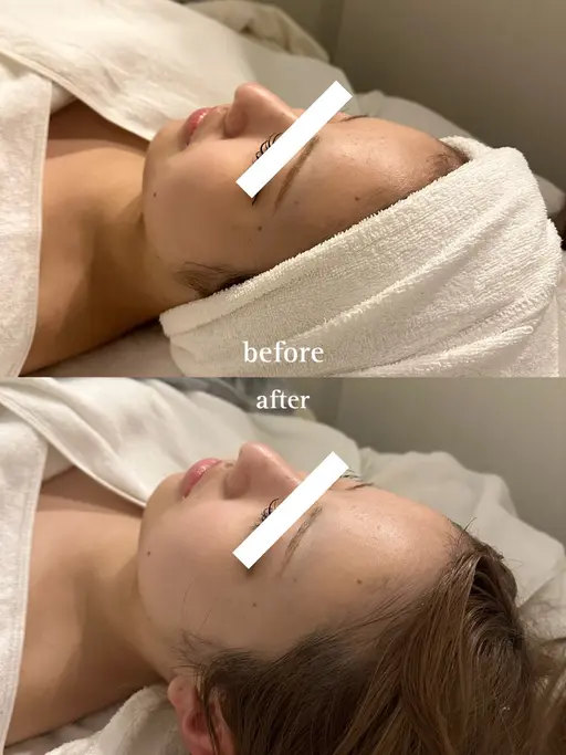〈人気NO1✨〉 暖かい石膏パックで陶器肌へ🤍 毛穴引き締め・ハリ・ニキビ跡に｜肩首リンパ×小顔マッサージ 60分