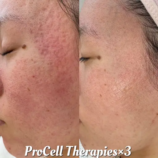 【肌質改善】無料カウンセリング(施術検討中の方)男性🙆🏻♀️プロセルセラピーズ