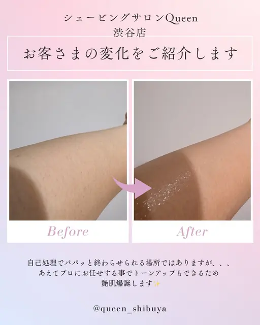 ミニモ&夏限定メニュー☀️ 背中全体+腕半分シェービング🪒