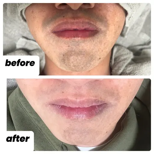 初回ヒゲ脱毛1回