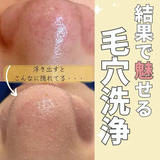 SNSで大人気の浮き出る毛穴洗浄