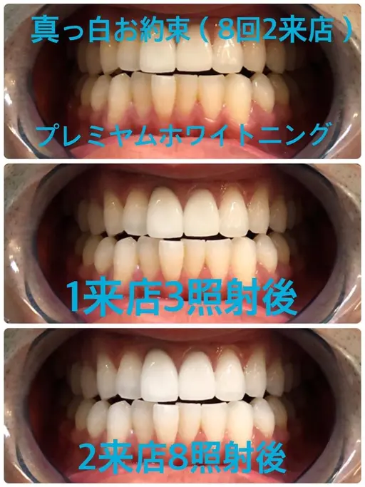 【初回限定】真っ白お約束🦷✨プレミアムホワイトニング❣️〈合計70分照射2来店コース〉❣️✨