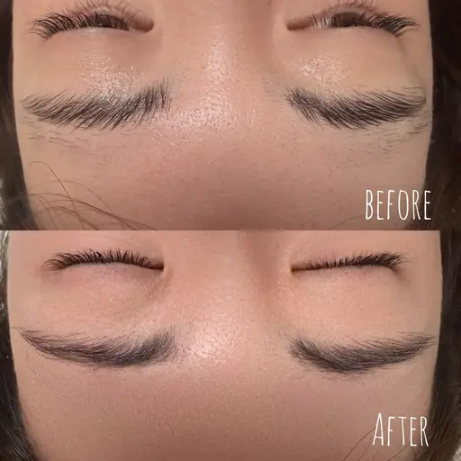 HBL(ハリウッドブロウリフト)