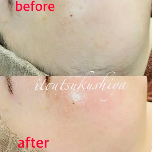 両頬の糸エステ体験🧵＋シートパック付き✨