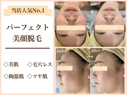 1番人気【🤍韓流美肌脱毛🤍】脱毛とフェイシャルのいいとこどり💕ピーリング+パックでつる艶🐻❄️毛穴/美白/小顔