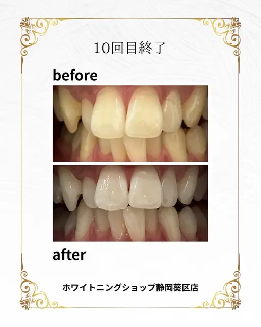 【静岡市にご勤務されている方限定】当店初回セルフホワイトニング40分8980円→0円