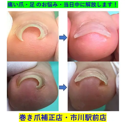 巻き爪矯正　1爪(google口コミ投稿特別価格)
