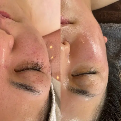 若くみえたい方に Lit プログラム導入３回コース（ヒト臍帯由来幹細胞上清液）